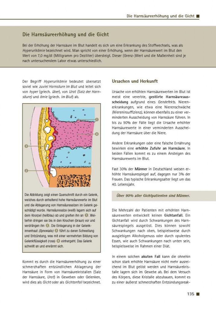 Die Harnsäureerhöhung und die Gicht