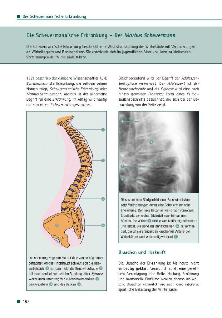 Die Scheuermannsche Erkrankung - Der Morbus Scheuermann