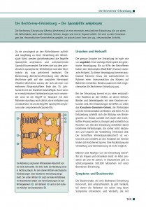 Die Bechterew-Erkrankung - Die Spondylitis ankylosans