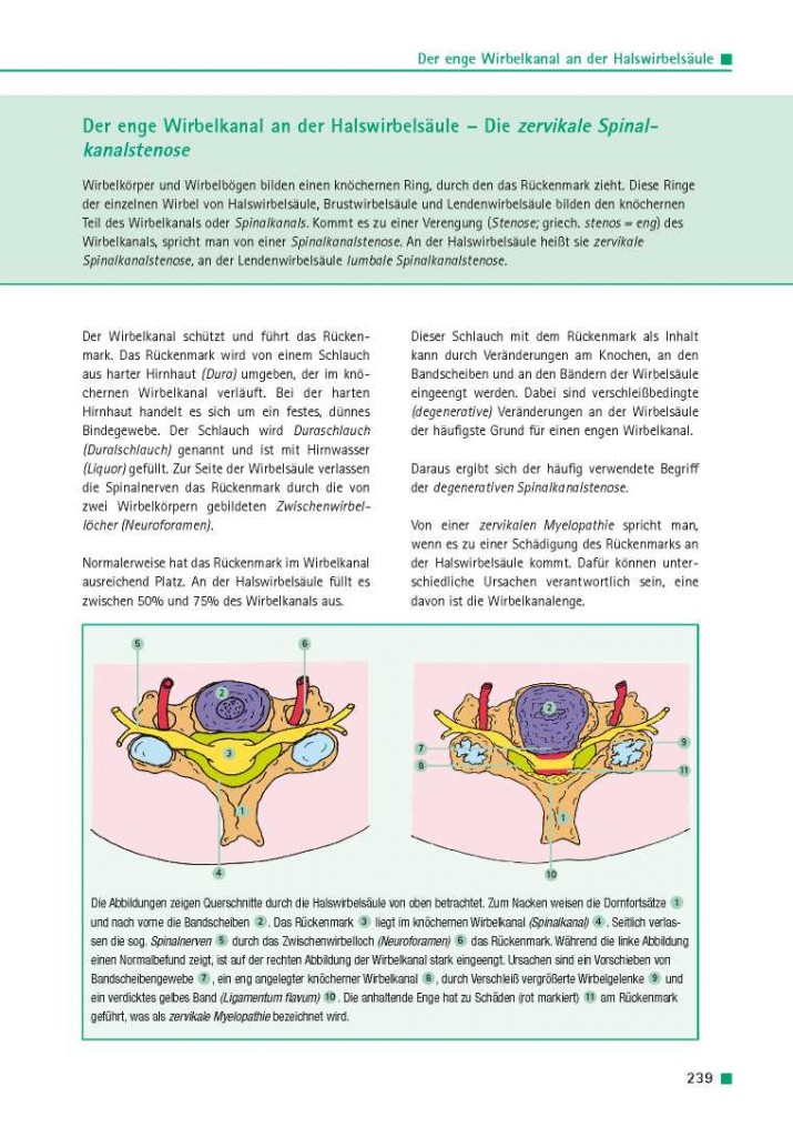 Der enge Wirbelkanal an der Halswirbelsäule – Die zervikale Spinalkanalstenose