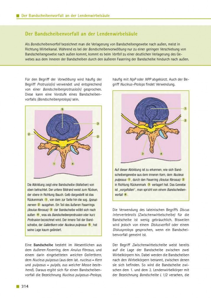 Der Bandscheibenvorfall an der Lendenwirbelsäule