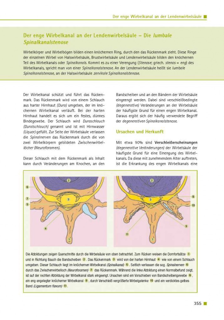 Der enge Wirbelkanal an der Lendenwirbelsäule – Die lumbale Spinalkanalstenose