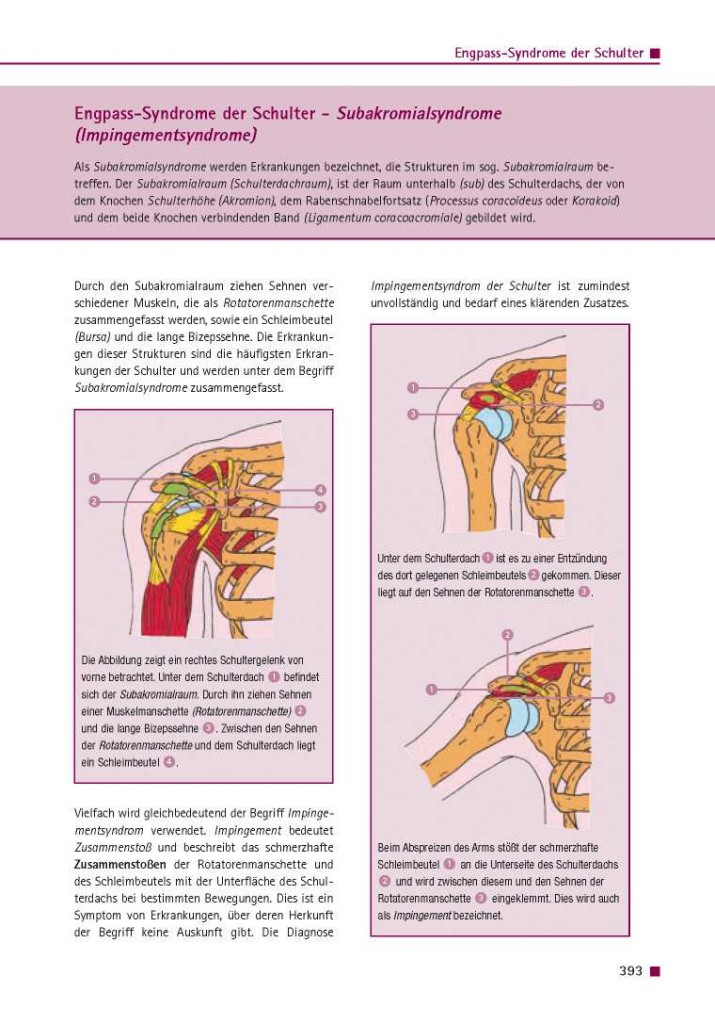 Engpass-Syndrome der Schulter – Subakromialsyndrome (Impingementsyndrome)