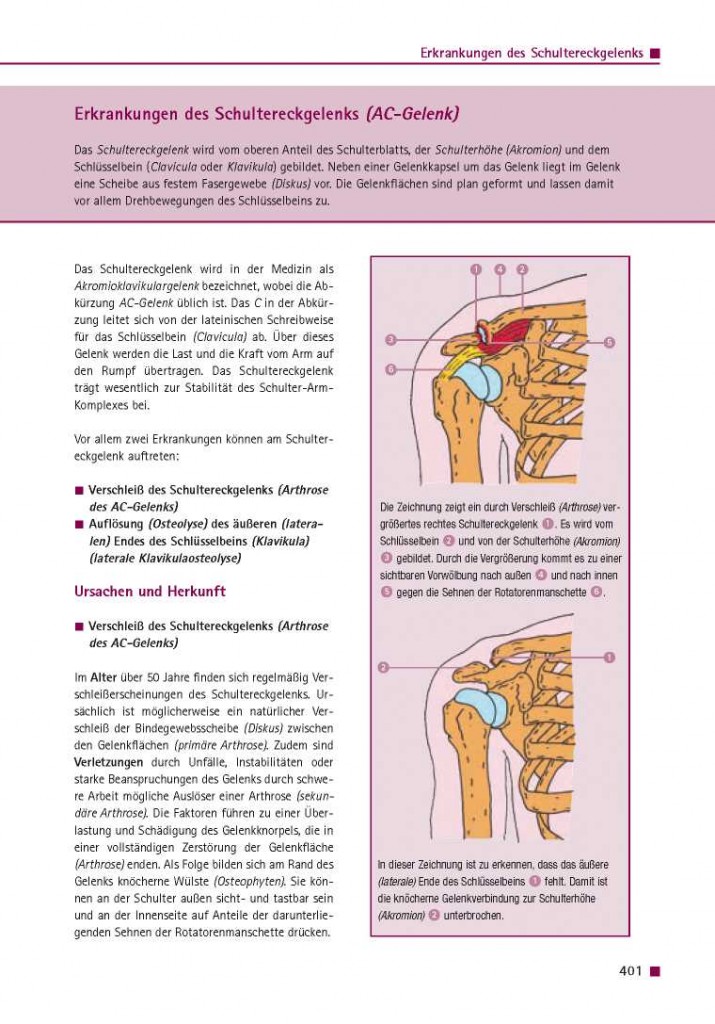 Erkrankungen des Schultereckgelenks (AC-Gelenk)