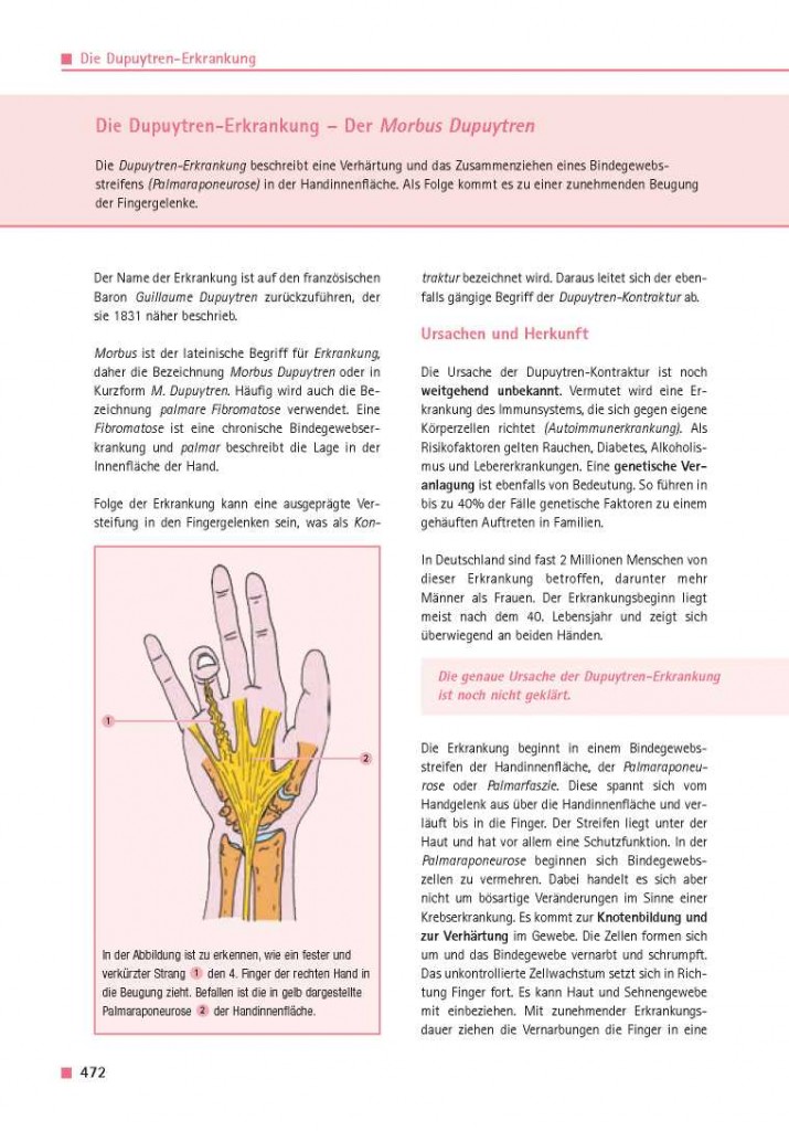 Die Dupuytren-Erkrankung – Der Morbus Dupuytren