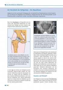 Der Verschleiß des Hüftgelenks – Die Koxarthrose