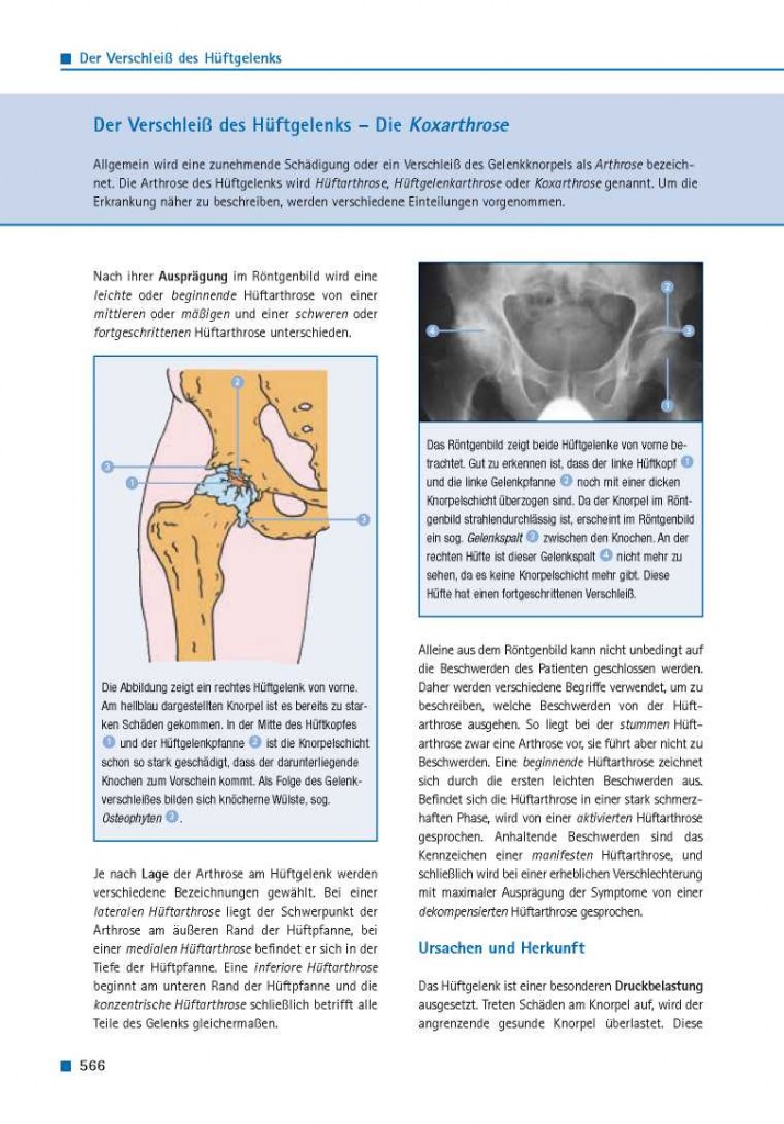 Der Verschleiß des Hüftgelenks – Die Koxarthrose