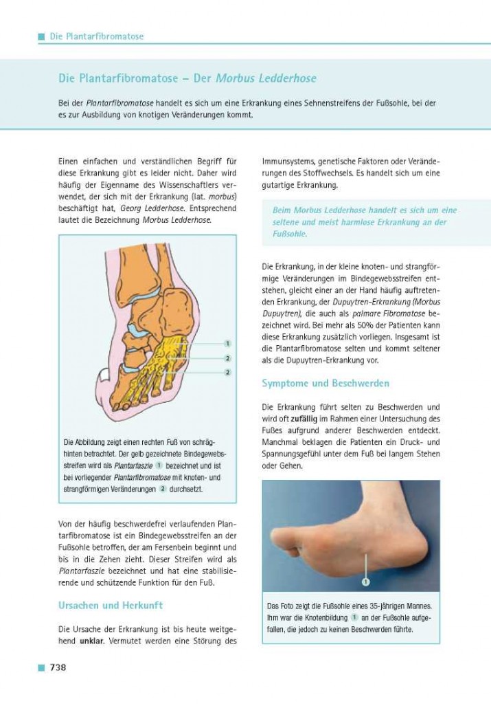 Die Plantarfibromatose – Der Morbus Ledderhose