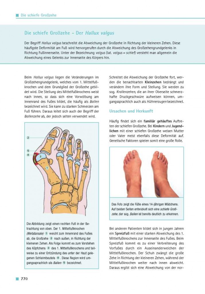 Die schiefe Großzehe – Der Hallux valgus